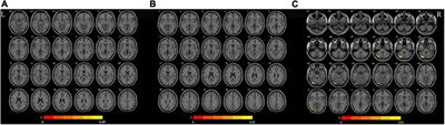 The Predictive Value of Dynamic Intrinsic Local Metrics in Transient Ischemic Attack